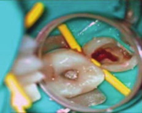 Case report one A 24-year-old female was referred to the Hospital University Sains Malaysia s Specialist Dental Clinic for the treatment of pain and swelling associated with her maxillary right