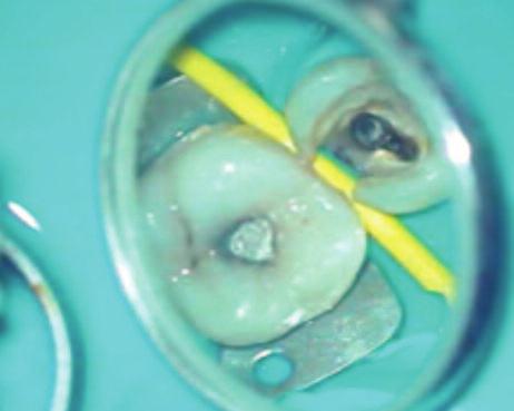 However, the problem persisted following endodontic treatment. Her previous medical history was unremarkable. Extra-oral examination revealed no abnormalities.