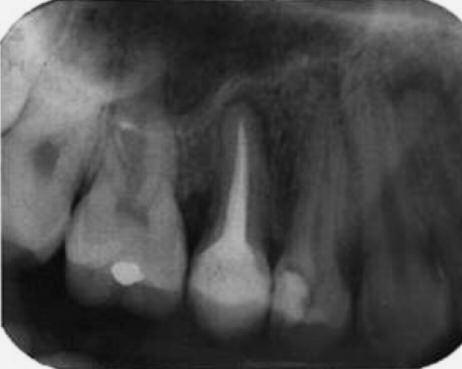 The tooth was tender to vertical percussion and apical palpation and had class I mobility. Periodontal probing showed a 6mm pocket at the distal of the tooth.
