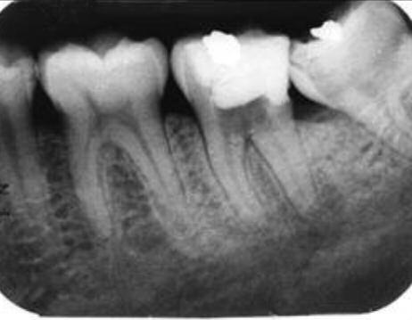 Figure 2a: Tooth 37 showing periapical radiolucency with furcal perforation. Figure 2b: Illustrated perforation site lingually.