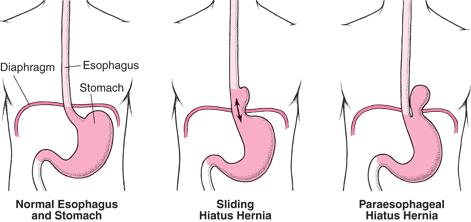 congenital hiatal hernia the esophagus fails to lengthen sufficiently