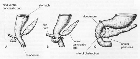 Pancreatic Abnormalities Annular pancreas the right portion of the ventral