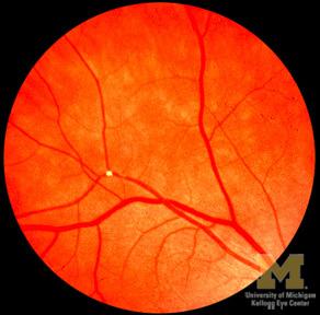 Symptoms Visual symptoms are due to ischemia of the retina.