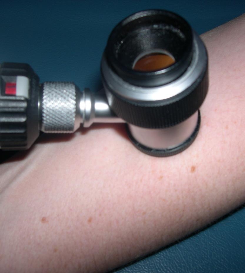 Dermoscopy Powerful tool to aid the diagnosis of benign vs. malignant pigmented skin lesions.