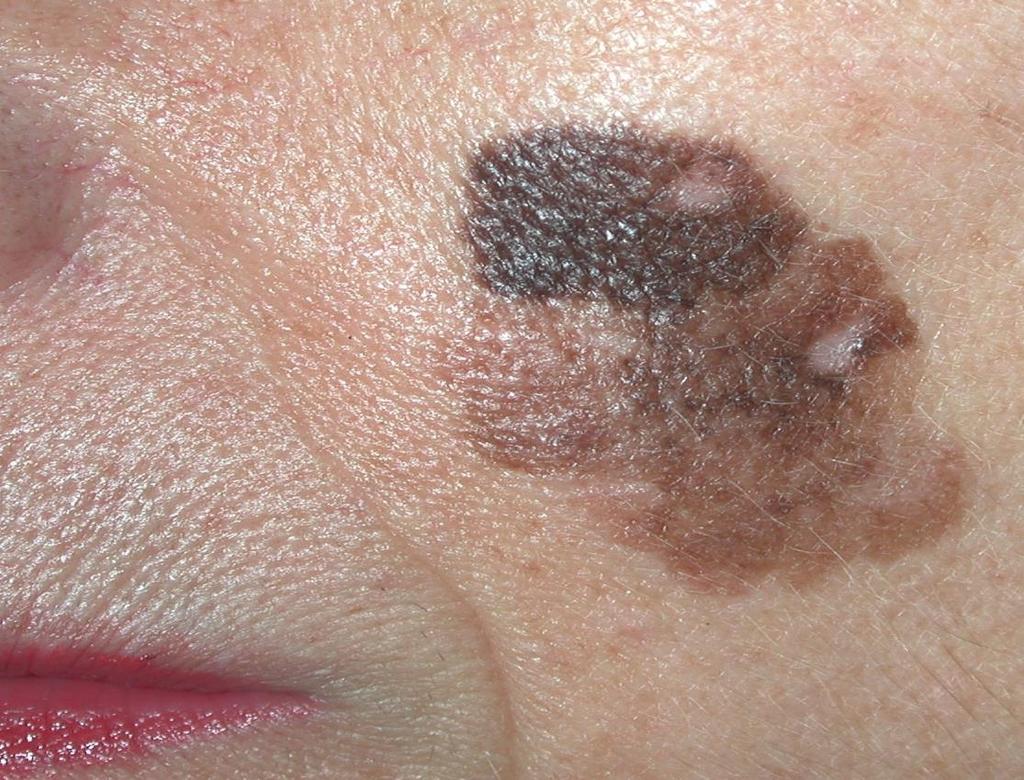 8/100,000 in US 2 Most common subtype of melanoma on face