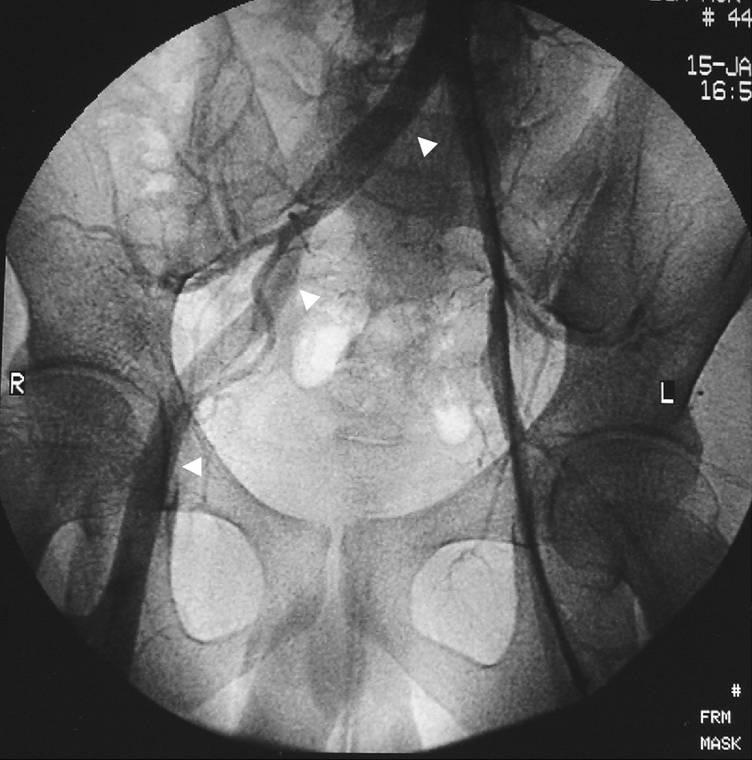 selective femoral arteriogram showed a dilated tortuous feeding artery and early enhancement of an enlarged draining vein and nidus, indicating VM (Fig. 6).