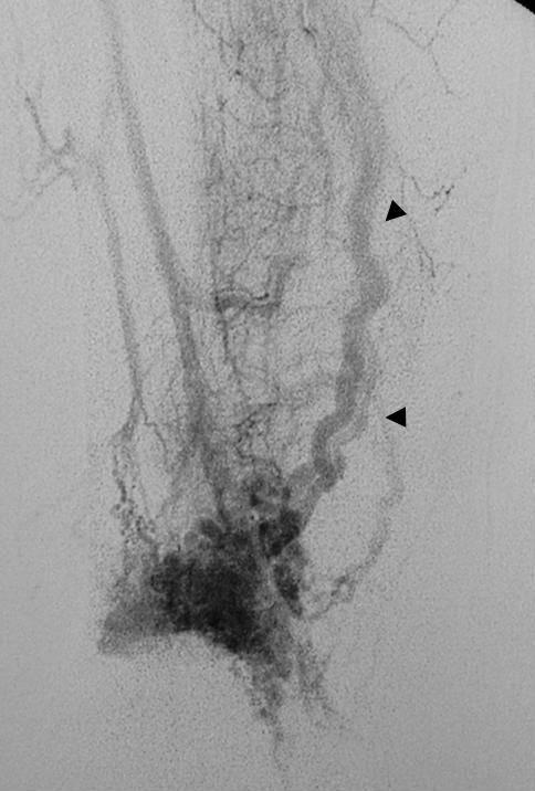 . Femoral angiogram shows an abnormal dilated feeding artery (arrows)