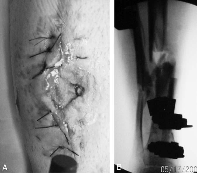 punctuate bleeding were visualized. After subperiosteal dissection of the fibula from a lateral approach, a segment was resected at the same level of the tibial defect.