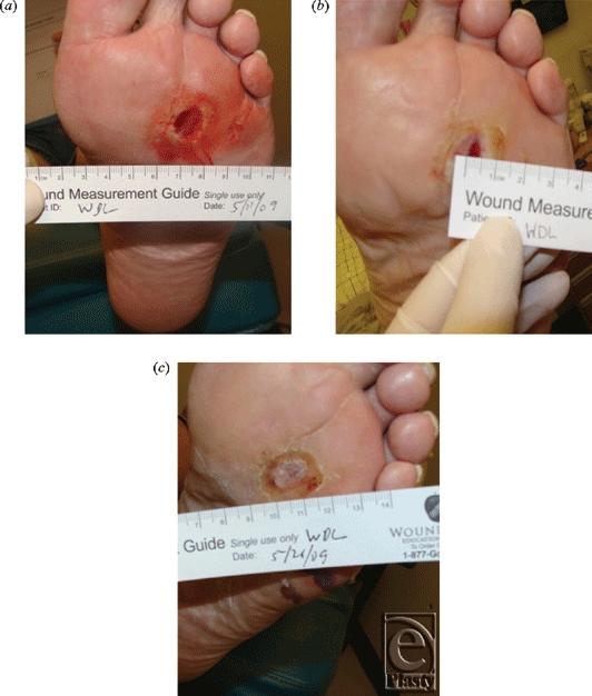 Three graft flap (5.0 split-thickness wound treatment. One infection given her negative The NPWT known Figure foot, and cm study serious ample of adverse system but day skin the after pressure 2. 7.