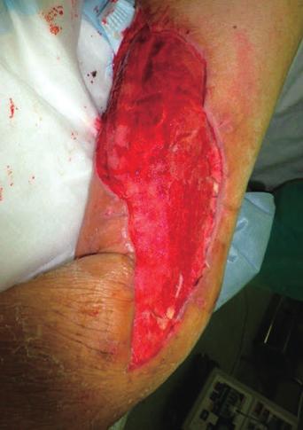 3 Following debridement, the vacuum-assisted closure (VAC) system was applied to the wound of the patient with NF. Fig.