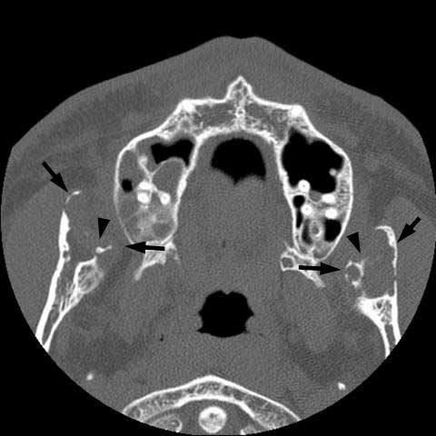 Considering these imaging findings, we considered brown tumor of hyperparathyroidism, ameloblastoma, odontogenic myxoma and odontogenic fibroma as possible options for making the differential