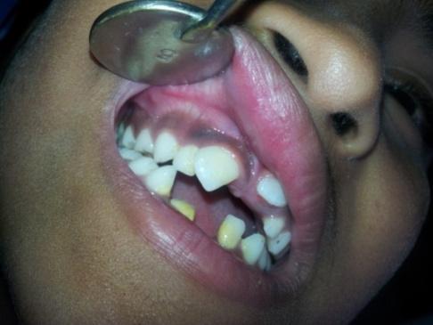 Intra oral appearance Non syndromic Multiple Keratocystic Odontogenic Tumour occurring in both the jaws.