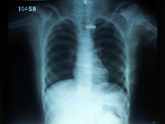 Fig6: chest radiograph In view of the multiple appearances of the cysts, chest