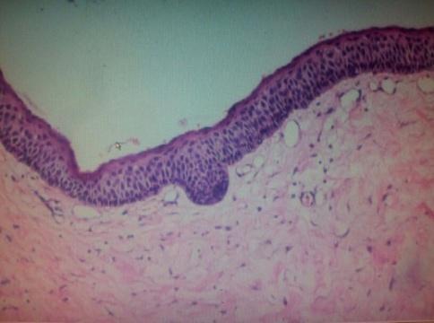 following which lesion was sent for histo-pathology for final evaluation.