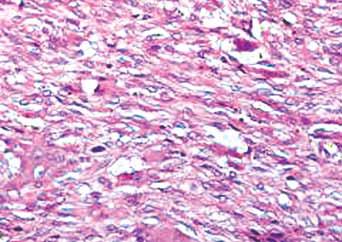(B) Stromal cells in older show hypocellular collagen (hematoxylin and eosin, 400) Surgical curettage was done in