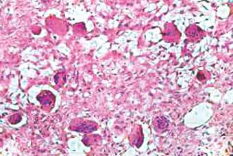 WJD Figs 9A and B: (A) Numerous multinucleate cells (4+) are seen in this photomicrograph (hematoxylin