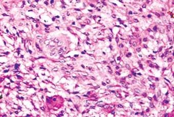 (B) A few giant cells lying in the background of benign stroma graded as 1+ (hematoxylin and eosin, 200)