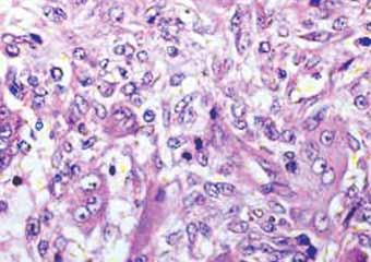 The final report in all cases was consistent with the diagnosis of central giant cell granuloma.