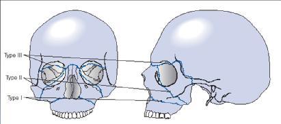 Facial Anatomy LeFort Fractures