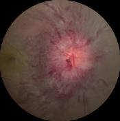 Clinical Features of Optic Neuritis with Low Risk of CDMS in Patients with No Brain MRI Lesions No cases of CDMS have developed when any one of the