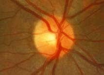 Optic Neuropathy Typical Optic Neuritis Inflammation of