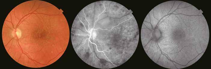 Case Reports Proliferative diabetic retinopathy Lateral: 12mm 12 Courtesy: Prof. P. E.