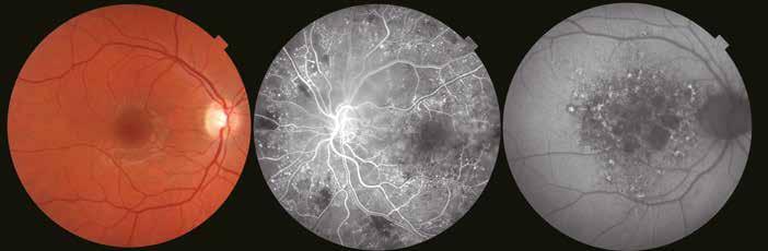 Central serous retinopathy Lateral: 12mm 13 Courtesy: Prof. P. E.
