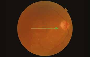 cataracts and hemorrhages, making it possible for more patients to be imaged.