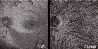 allows for independent dissection of the vitreoretinal interface, retina, retinal pigment epithelium (RPE), and choroid by flattening the