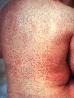 Rash Diaper Rash Keep area dry, diaper off baby if needed, zinc oxide cream may help or ointment may delay healing If rash is red, in