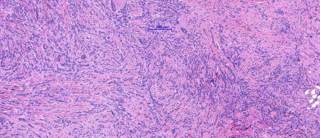 Invasive lobular carcinoma Discohesive cells, single-file infiltrating pattern (