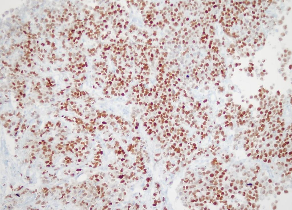 Immunohistochemistry Estrogen and progesterone: nuclear