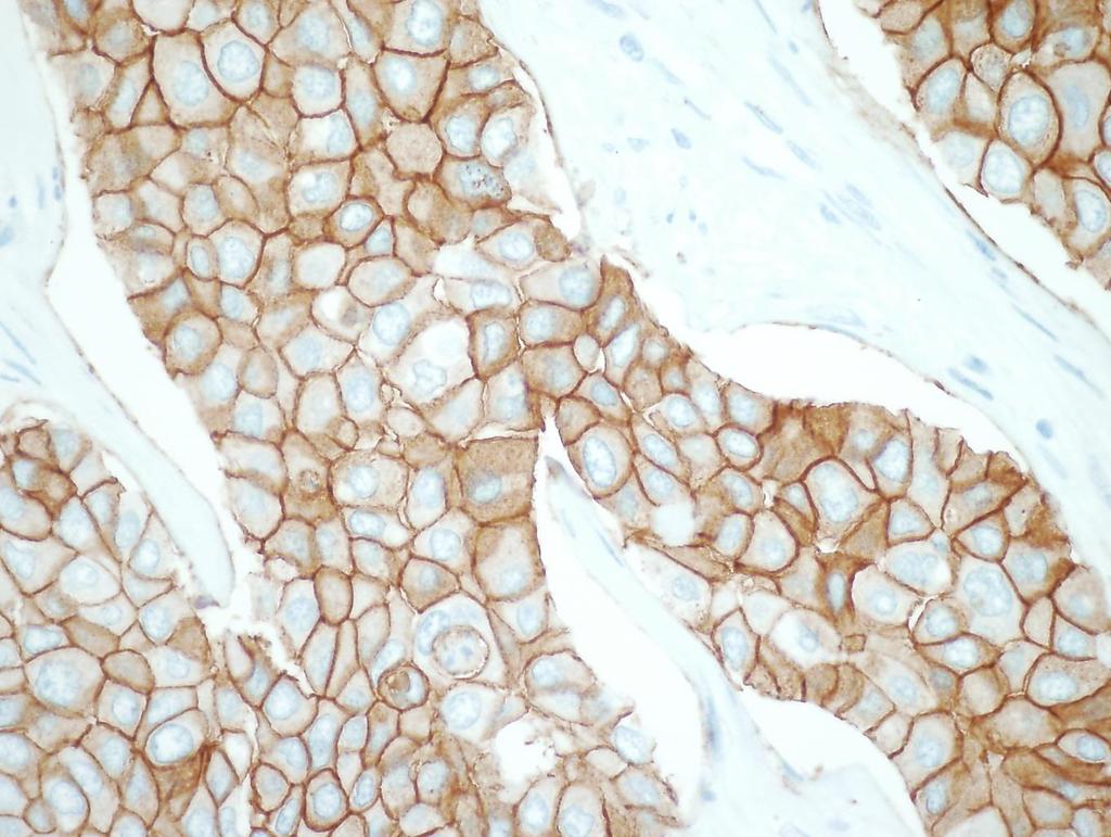 Immunohistochemistry HER2 In equivocal cases FISH examination can verify the HER2 status Clinical significance: