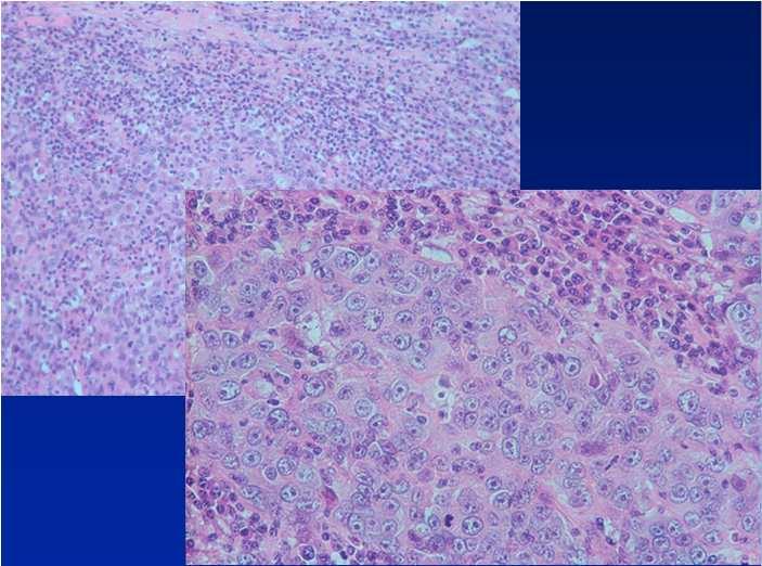 Infiltrating Lobular Carcinoma Morphological features Composed of small regular cells identical to those seen in LCIS The cells are usually dissociated from each other and form single files and