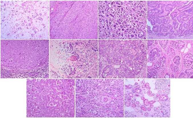 types of breast cancer have distinct molecular subtypes? Medullary Metaplastic Secretory Adenoid cystic Apocrine Pleomorphic lobular Acinic Reis-Filho et al.