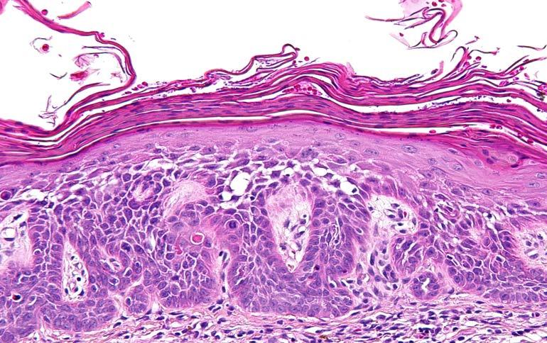 Actinic Keratosis Keratinocyte tumors Prepared by Kurt Schaberg Precancerous, risk of malignancy ~8-20% per year (progresses to SCC); Due to chronic sun exposure Rough scaly plaque; typically due to