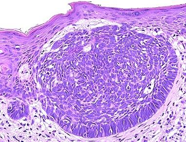 However, basal cell carcinoma tumor cells should have darker chromatin, more apoptosis and mitoses, and paler cytoplasm than the hair follicles.