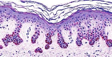 Infiltrative Horn cysts Interlacing pigmented epidermal strands Acanthosis Hyperkeratosis Solar lentigo aka lentigo senilis, age spot Dirty feet