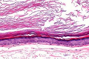 Epithelial Cysts More Skin Tumors Epidermal Inclusion Cyst (EIC) Acquired unilocular cyst due to trauma, etc.