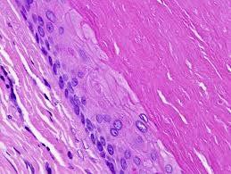 but with hair follicles and sebaceous glands Pilar (Trichilemmal) Cyst Filled with dense, wet eosinophilic keratin Stratified squamous epithelium Granular layer generally absent Sebaceous