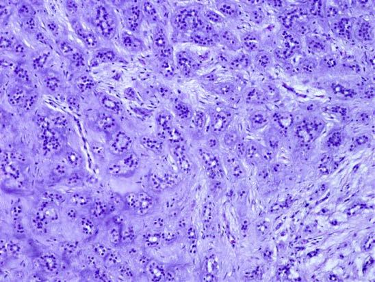 jigsaw puzzle-like pattern Chondroid Syringoma aka Cutaneous mixed tumor Essentially a pleomorphic adenoma, but primary to the skin Epithelial cells embedded in myxoid, chondroid, or