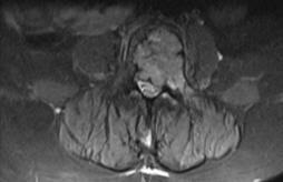 Spine Radiosurgery Benefits Single session Higher dose to tumor (