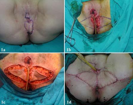 C. M. Ercan et al / Surgery in a persistant lichen sclerosus case patient with persistent lichen sclerosis, who underwent surgical management reconstruction of the vulva with V-Y advancement flaps. 2.