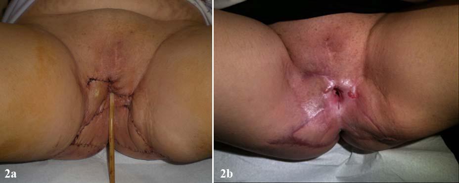 Fig. 2. Postoperative pictures of the vulvar lichen sclerosus patient. 2a; second post operative second day, 2b; completed vulvar healing three weeks after surgery. 3.