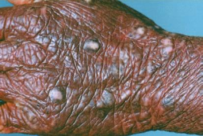 T h e n e w e ngl a nd j o u r na l o f m e dic i n e Figure 2. Prurigo Nodules on Lichenified Skin in a Patient with Chronic Pruritus.