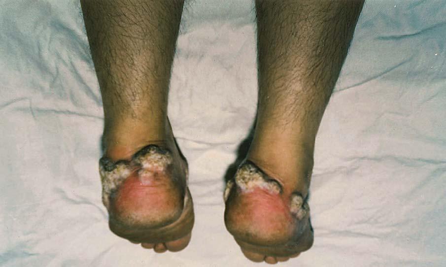 Serbian Journal of Dermatology and Venereology 2014; 6 (2): 73-80 M. Paravina Lichen planus hypertrophicus other parts of the foot.