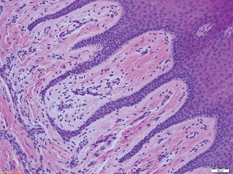Photomicrograph of the skin with a thick keratotic layer, moderately thick granular layer of the epidermis and mild acanthosis and