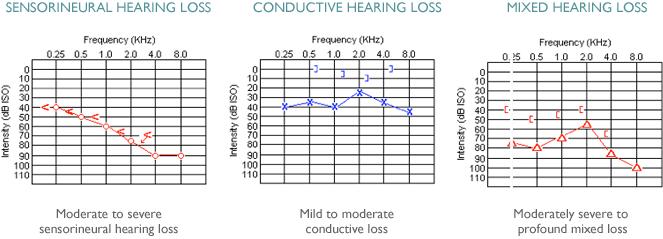 audiograms: Air conduction: (X) = left ear; (O) =