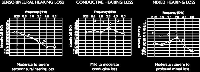 Bone conduction: ] = left ear; [ =  Intensity is