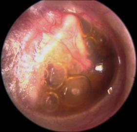 Treatment: If there is discharge swab for culture. Clean the ear under magnification with irrigation/suction and keep it dry. Bacterial etiology: Ciprofloxacin ear drops.